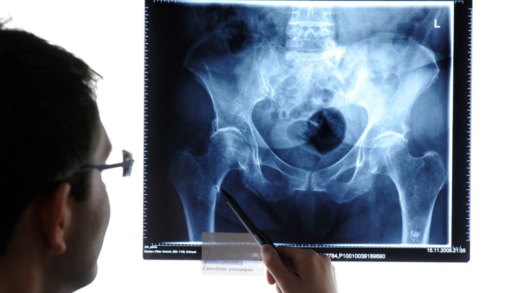 Arzt untersucht das Röntgenbild eines Patienten. Er zeigt mit einem schwarzen Stift auf eine bestimmte Stelle des Bildes.