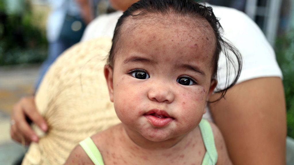 Philippinisches Kind, das an Masern leidet. Quelle: WDR/dpa